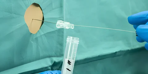 Extracción de líquido cefalorraquídeo durante punción lumbar